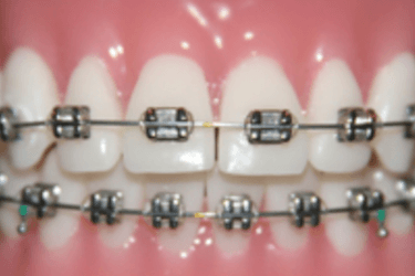 tratamiento de ortodoncia metalica ortodoncia brackets metalicos