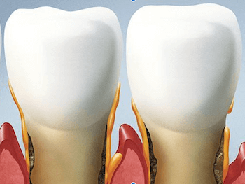 tratamiento-encias-dentista-periodoncista periodoncia
