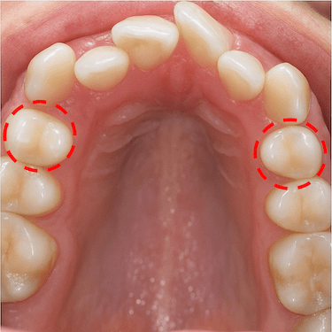 Extracción por motivos ortodónticos