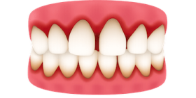 Enfermedad periodontal