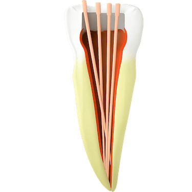 Limpieza del conducto: eliminar el nervio dañado o “matar el nervio de la muela”