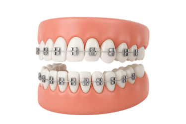 Ortodoncia tradicional