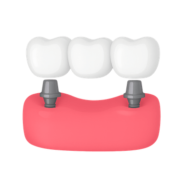 ¿Cuánto cuesta un puente dental de 3 piezas?