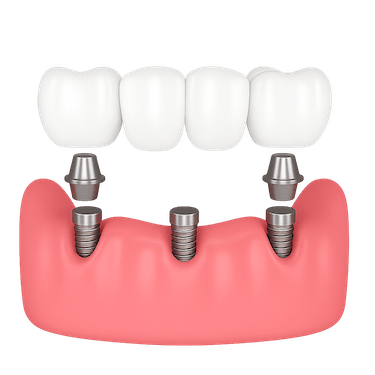 ¿Cuánto cuesta un puente dental de 4 piezas?