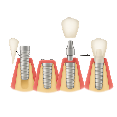 ¿Cómo es el proceso de colocación de un implante unitario?