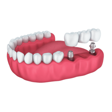 Puente con implantes