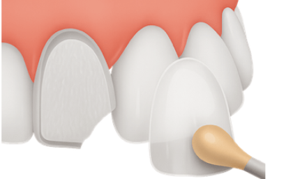 Reparar dientes fracturados