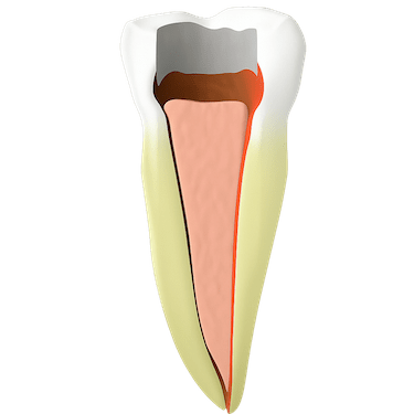 Sellado del conducto: rellenar el interior del diente para evitar infecciones