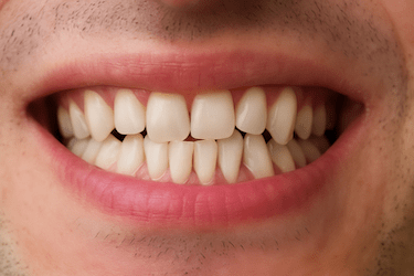 Solución para dientes torcidos y apiñados