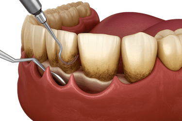 Cirugía periodontal