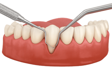 Cirugía periodontal