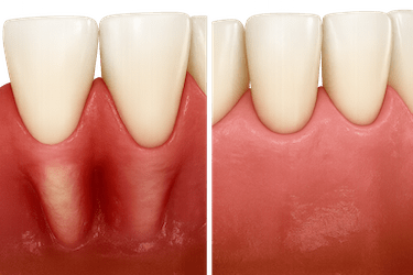 Cirugía colgajo dental