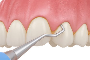 Curetaje, raspado o alisado radicular