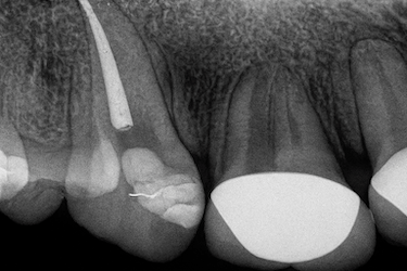Endodoncia unirradicular