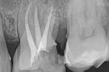 Endodoncia multirradicular