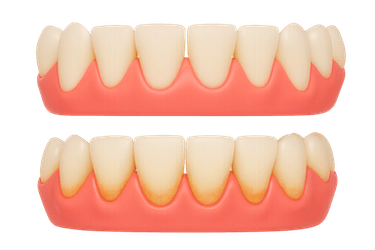 Mantenimiento periodontal