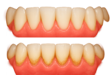 Mantenimiento periodontal