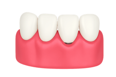 Tratamiento de periimplantitis