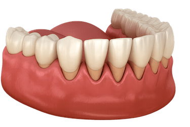 Dientes que se mueven y puedes perder