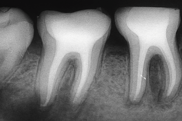 Endodoncia birradicular