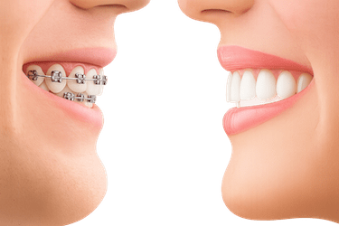 Opciones de ortodoncia en Murcia