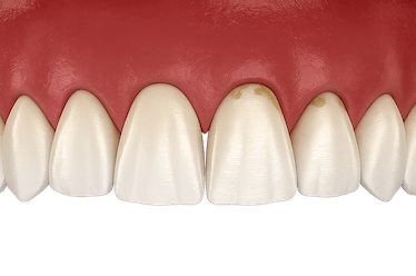 Encías retraídas y sensibilidad dental