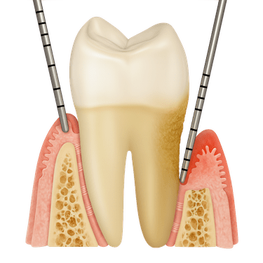 Bolsas periodontales