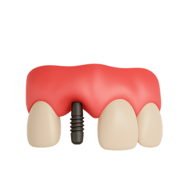 Colocación de implantes dentales