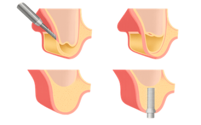 Elevación de seno maxilar