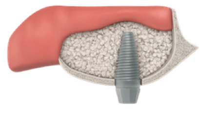 Técnica de elevación del seno maxilar