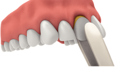 Exodoncia dental para implantes