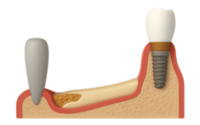 Ensanchamiento del hueso maxilar