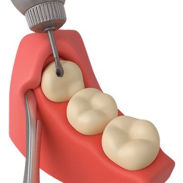 Extracción quirúrgica compleja