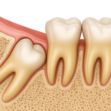 Extracción cordal incluido