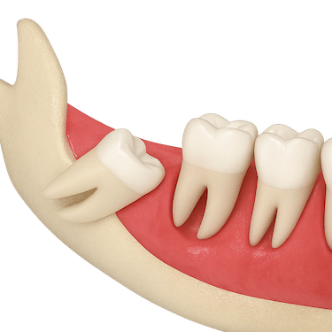 Extracción cordal semi incluido
