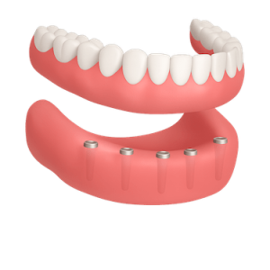 Prótesis híbrida sobre implantes