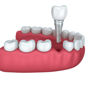Implante dental unitario