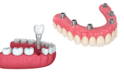 Tratamientos de Implantología