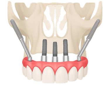 Implantes cigomáticos
