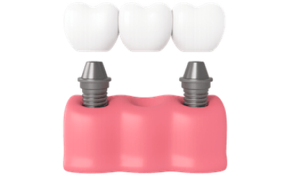 Puente sobre implantes dentales