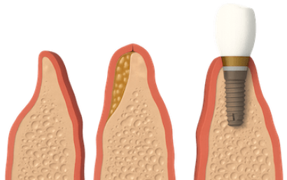 Injerto óseo para regeneración dental