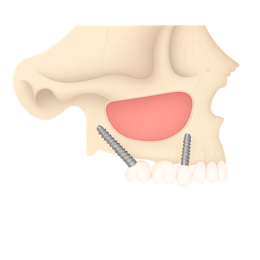 Implantes pterigoideos