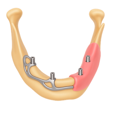 Implantes subperiósticos