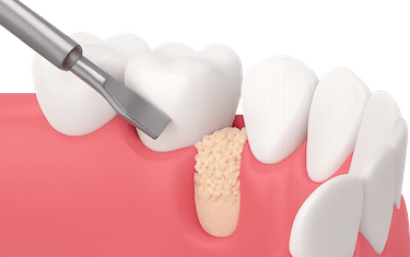 Injerto de hueso dental
