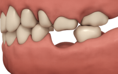Dientes desplazados por ausencia de un diente
