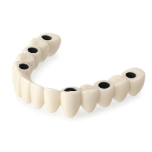 Prótesis dental fija sobre implantes