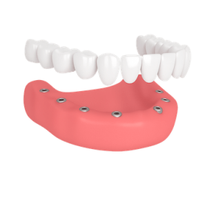 Prótesis dental fija de porcelana sobre implantes