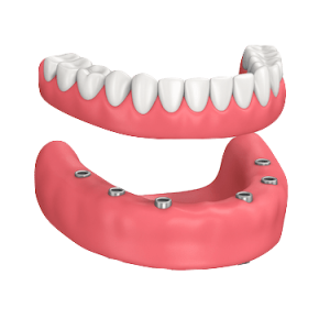 Prótesis hibrida sobre implantes
