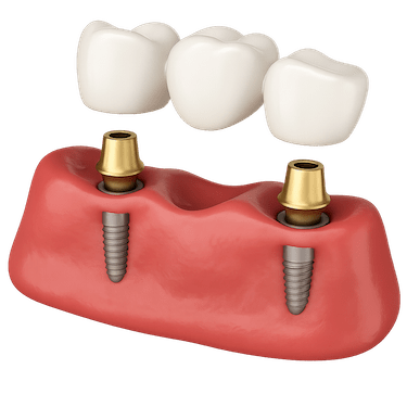 Puente con implantes