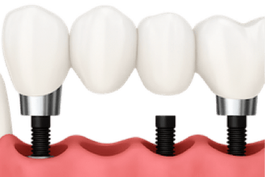 Falta de varias piezas dentales